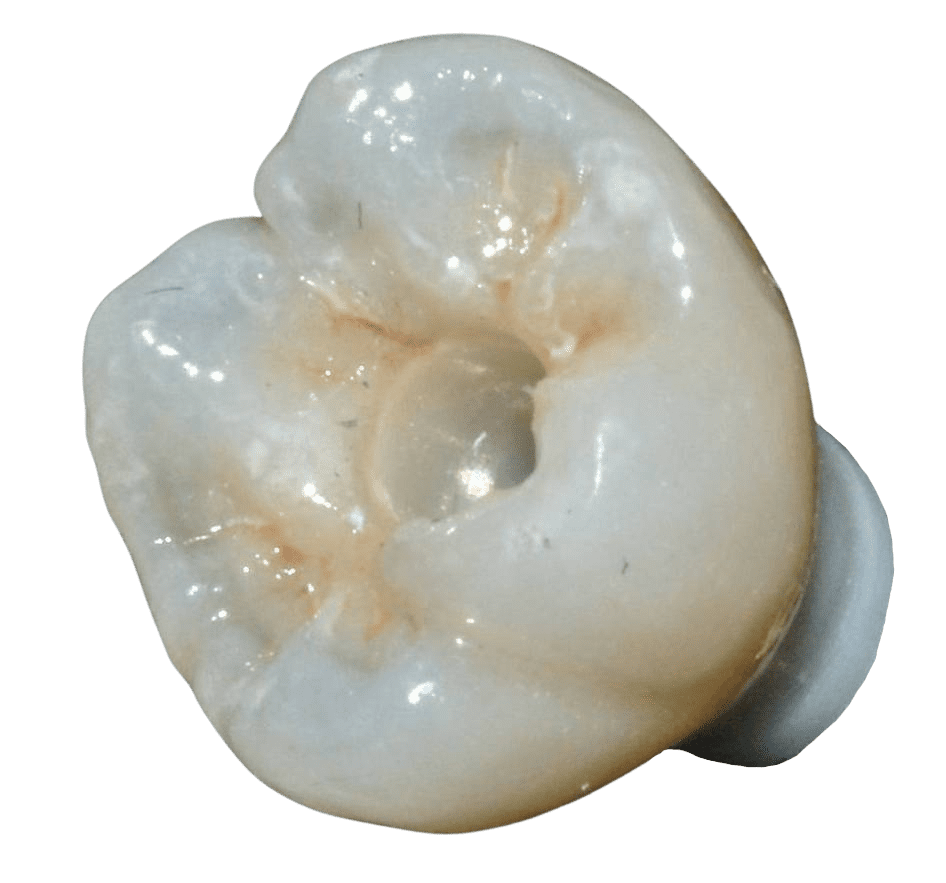 Screw Retained Implant